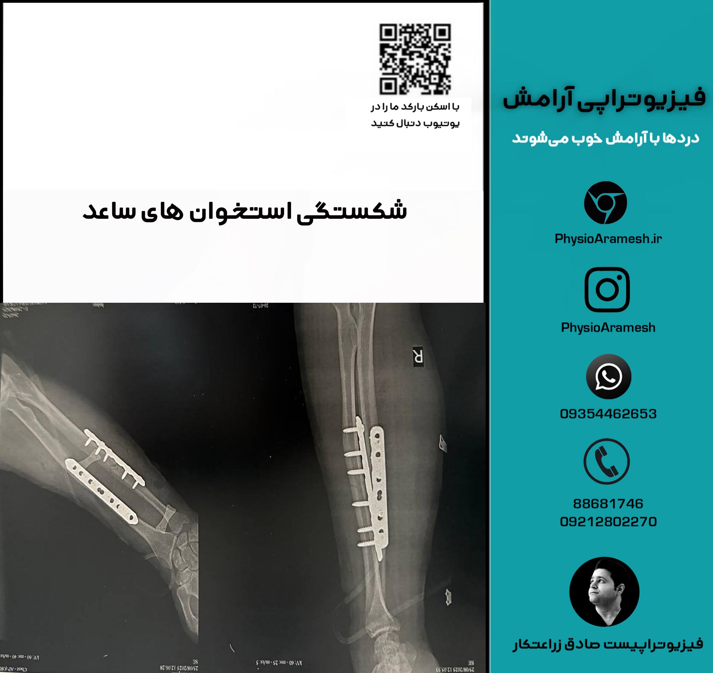 شکستگی استخوان های ساعد